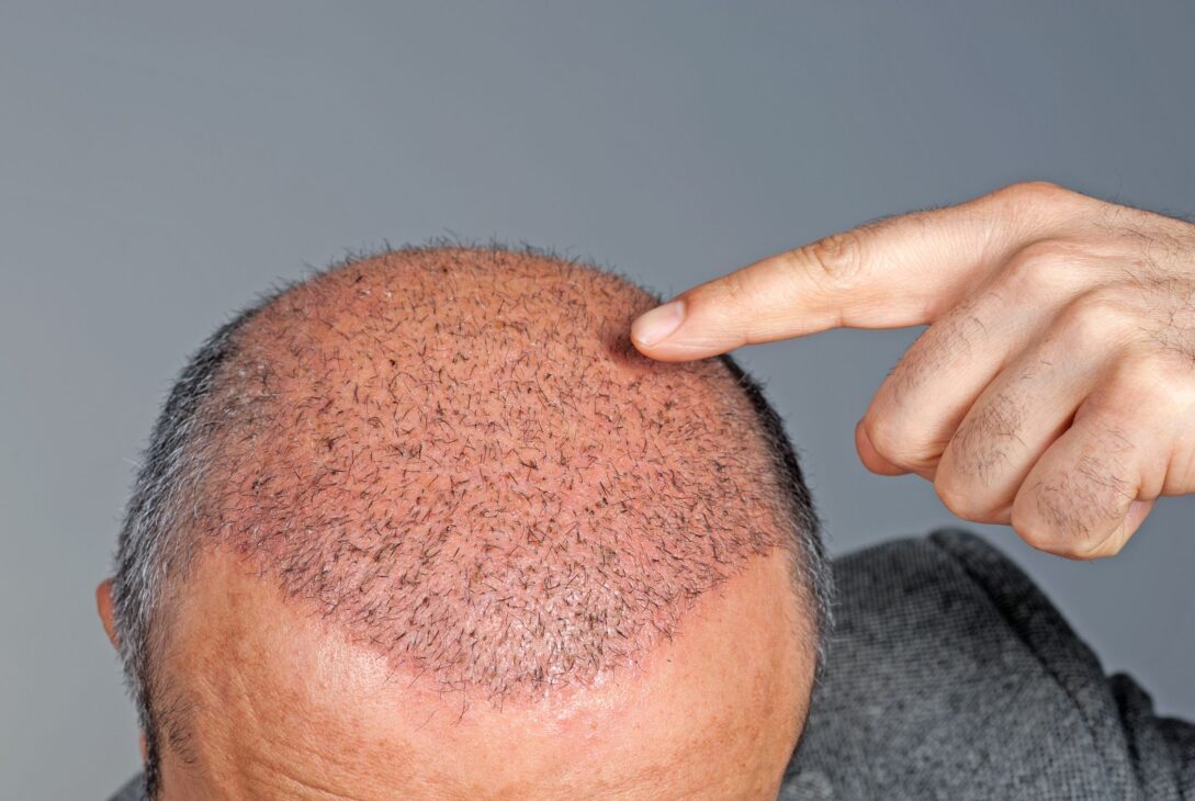 hair transplant royalty free image 164653183 1547124473 - voozon.com
