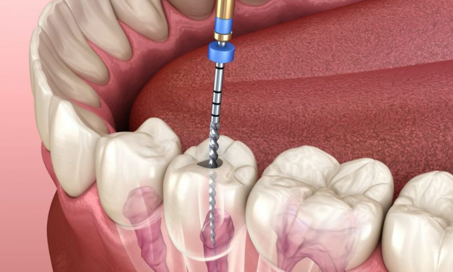 ROOT CANAL TREATMENT A COMPREHENSIVE GUIDE - voozon.com