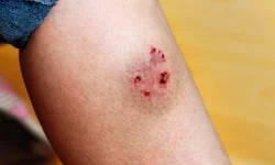 Were You Bitten By a Dog? Here Are 4 Things to Know