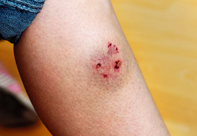 4 Things to Know About Dog Bites