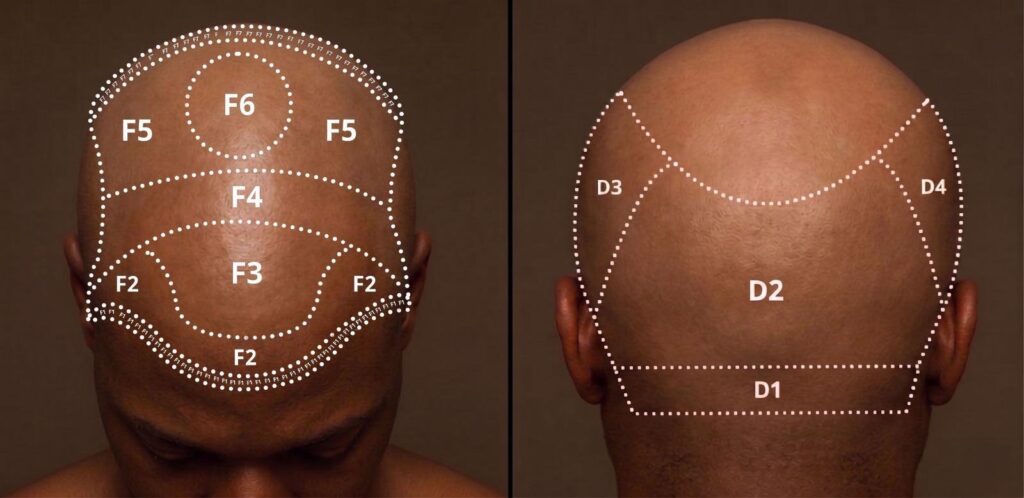 Best Afro Hair Transplant Clinic in Turkey | Istanbul Vita 2 - voozon.com image - voozon.com