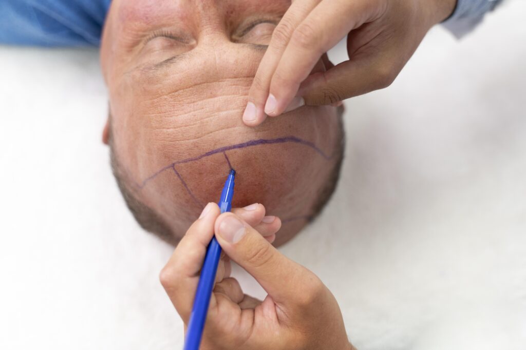 bold man going through follicular unit extraction process 23 2149106344 - voozon.com